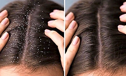 Dandruff: ತಲೆಹೊಟ್ಟು ನಿವಾರಣೆಗೆ 8 ನೈಸರ್ಗಿಕ ಮನೆಮದ್ದುಗಳು