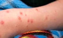 ಚಿಕನ್‌ ಪಾಕ್ಸ್‌ : ಮುನ್ನೆಚ್ಚರಿಕೆಗೆ ಸೂಚನೆ; ದ.ಕ.ದ 19 ವಿದ್ಯಾರ್ಥಿಗಳನ್ನು ಬಾಧಿಸಿತ್ತು