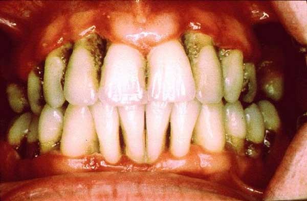 chronic-periodontitis.jpg