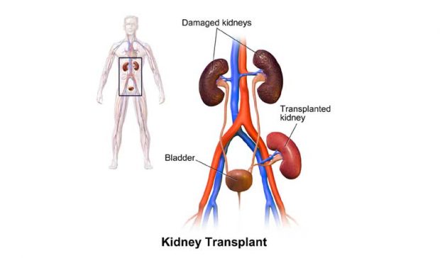 Kidney-Transplant.jpg