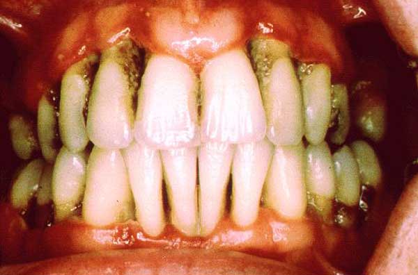 Tooth-disease–600.jpg