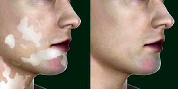 vitiligo-before-after.jpg