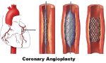 3-coronary-angioplasty