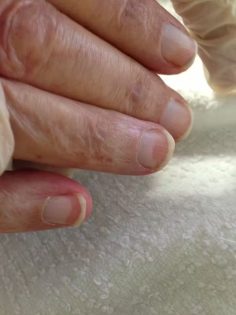Typical ground glass appearance of Terry’s nails. Credit: Hojasmuertas/Wikimedia commons